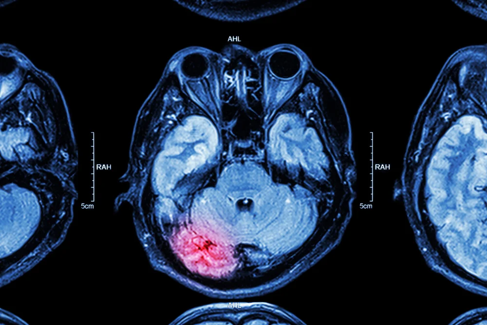 arlington tx brain injury lawyer